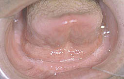 Fig.2 : Aspects cliniques de la crête mandibulaire (C.C.T.D)