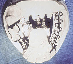 Fig.5b : Taquet occlusal en distal de la dent terminale de la selle libre, ce qui empêche le mouvement de rotation distale verticale de s’exprimer, donc action scoliodontique de cette dent et résorption accélérée de la crête édentée.
