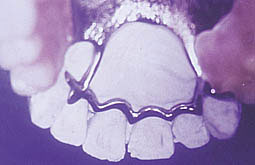 Fig. 7 : Barre cingulaire reposant directement sur les collets des dents, donc elle ne prend plus le nom de barre cingulaire mais plutôt de barre cervicale.