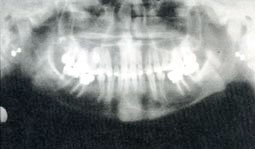 Fig.1 : Orthopantomogramme: image radioclaire s'étendant de la 33 à la 42