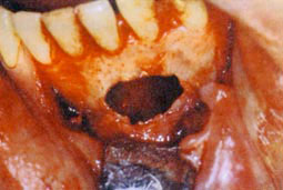 Fig.3 : Lacune osseuse. Noter l'absence de paroi kystique
