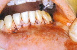 Fig.5 : Mise en place du lambeau et suture
