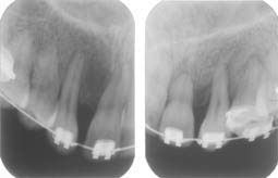 Fig. 13 : Rétro-alvéolaire montrant l’état des racines de la 13 et 23 après leur mise en place chirurgico-orthodontique
