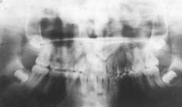 Fig. 16 : Radiographie panoramique montrant la présence de canines maxillaires incluses