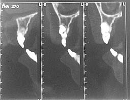Fig. 5 : Coupes sagittales montrant le degré de rhizalyse de la 22 au niveau de la face mésiale, l’axe, puis la face distale de la dent.