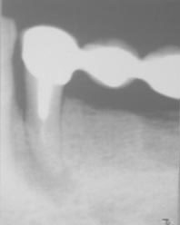 Fig. 4 : Image latérale et apicale sur une dent portant une prothèse avec RCR