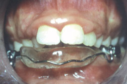 Traitement orthodontique d'un cas de classe Il 1 sans extraction