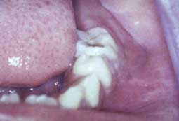 Fig. lb : Comblement du fond du vestibule en regard de la dent causale (2ème molaire temporaire inférieure gauche) chez la même patiente