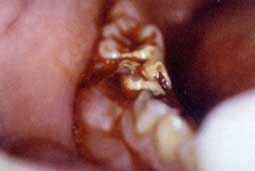 Fig. 7b : Examen endobuccal montrant une tuméfaction, la dent causale (ici dent recouverte de vernis ; problème de douleur !!)