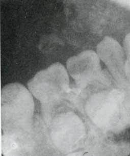 Fig. 7c : Image radiographique montrant la dent causale cariée