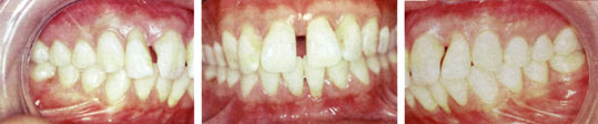 Figures 5 : Vues buccales avant le traitement parodontal