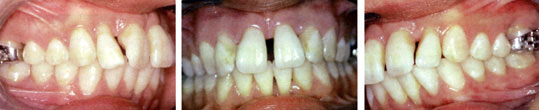 Figures 6 : Vues buccales. après traitement parodontal, début du traitement ODF