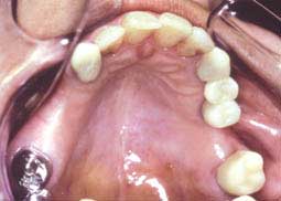 Fig. 5 : Couronnes provisoires au maxillaire au niveau de la 13, 23, 24, 25 et 26 (C.C.T.D)