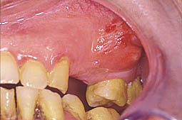 Fig. 1 : Aspect clinique d'un abcès parodontal en regard  de la face vestibulaire de la 27