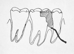 Fig. 4 :  schema illustrant un amalgame débordant, considéré comme un facteur étiologique du syndrome du septum