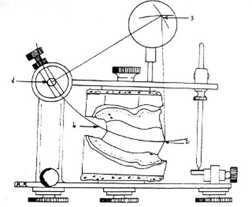 Fig. 3  : Réglage du Plan d’occlusion PO selon la technique de WADSWORTH (6).