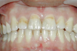 Dents restaurées et polies : reproduction de la forme, de la teinte et restauration du contact inter incisif.