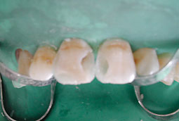 Fig.5b : la couche de composite « émail » palatin est étalée sur la matrice, puis polymérisée. Ainsi les territoires anatomiques de chaque dent sont-ils délimités.