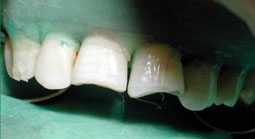 Fig.8 : Un chanfrein est réalisé en vestibulaire et palatin, les surfaces dentaires sont traitées par un mordançage, primer et adhésif après mise en place du champ opératoire.