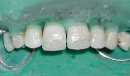 Fig. 9b : Mise en place des lobes dentinaires en teinte opaque sur la couche d’émail palatin.