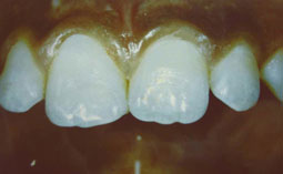 La 11 après collage du fragment dentaire fracturé. Une continuité parfaite est observée entre la dent fracturée et le fragment collé.