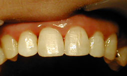 La reconstitution terminée, le composite est poli, la structure dentaire est reproduite dans sa teinte et sa forme.