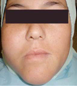 Fig.2 : Vue de  face montrant la présence d’une tuméfaction jugale droite volumineuse à l’origine d’une asymétrie faciale.