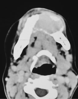 Fig.6 : TDM maxillaire en coupe coronale, tumeur ostéolytique au niveau du sinus maxillaire droit et de l’os maxillaire droit.