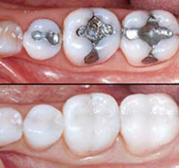 amalgame dentaire et alternative
