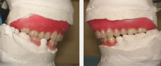 Fig.13: Montage des dents.
