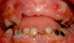 Fig.6 : Enfant de 5 ans avec des lésions carieuses sur toutes les dents,  les incisives inférieures n’ont pas été épargnées pour ce cas. Abcès paruliques et fistules en regard des dents atteintes.