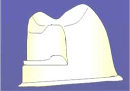 Schéma de la préparation de la face mésiale d’une prémolaire support d’un crochet équipoise.