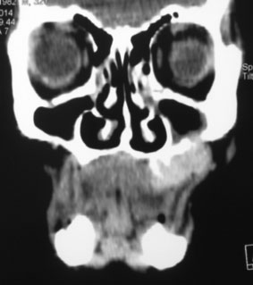 Coupe coronale notant l’effraction du plancher sinusien maxillaire.