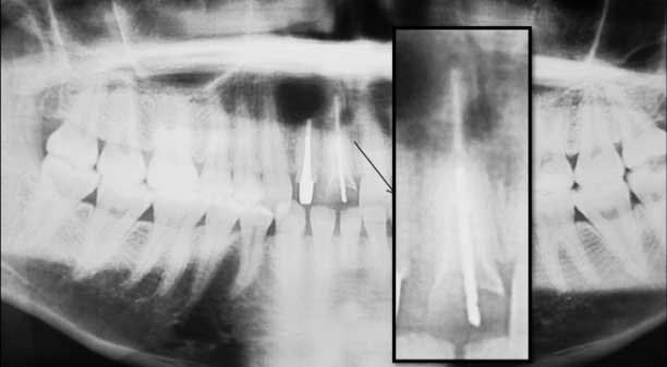 L’examen radiographique révèle la présence d’une image périapicale radioclaire en regard de la 12 porteuse d’un inlay core et sur laquelle une résection apicale a été effectuée. La 11 présente des parois radiculaires très fines et une petite image périapicale. (Chirurgie endodontique effectuée par Pr Kh AMINE du service de parodontologie du CCTD de Casablanca).