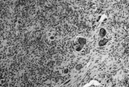 Microphotographie d’un FO composé de cellules fibroblastiques et des dépôts calcifiés (HE #200)