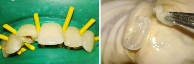 Application de l’adhésif sur dent et fragment.
