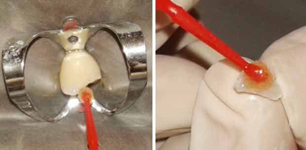 Après séchage, application de l’adhésif au niveau de la dent et du fragment.