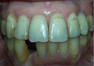 Colorations dentaires après 10j d’usage de la chlorhexidine..