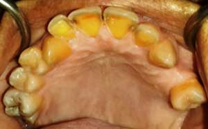 Érosions des surfaces palatines des dents.
