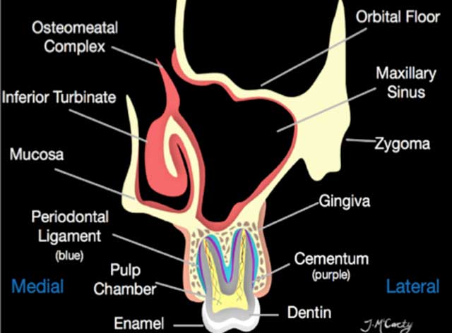 Fig 3 : Anatomie du sinus maxillaire (10).