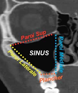 Fig 2 : Les parois du sinus maxillaire.