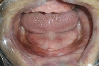 Fig5: Aspect clinique : crête mandibulaire résorbée (Cl III d’Atwood).
