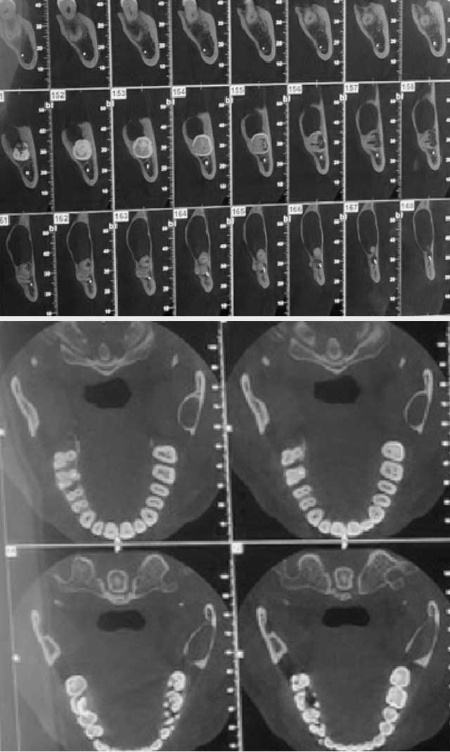 Tomodensitométrie par faisceau conique montrant l’amincissement des corticale ainsi que le trajet du nerf alvéolaire inférieure qui est en rapport avec la dent de sagesse incluse.