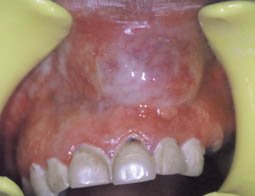 Fig.10 :  Aspect clinique d’une tuméfaction comblant le fond du vestibule en rapport avec la présence d’un kyste radiculo dentaire en relation avec les apex des 21 et 22
