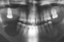 Fig.4 : Radiographie panoramique montrant la présence d’un kyste latéro radiculaire en rapport avec les racines des 44 et 45