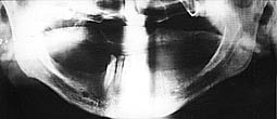 Fig.5 : Radiographie panoramique révélant la présence d’un kyste résiduel maxillaire