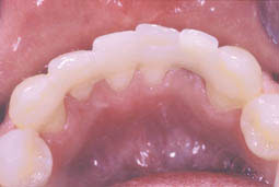 Fig. 4b  :  Remplacement de 32 par dent en composite et CRF (2)