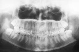 Fig. 2 : Panoramique montrant une dent surnuméraire, para molaire située derrière les deux prémolaires supérieures et un mesiodens supérieur