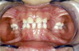 Agénésie dentaire 1