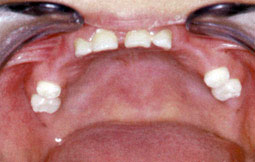 Agénésie dentaire 2